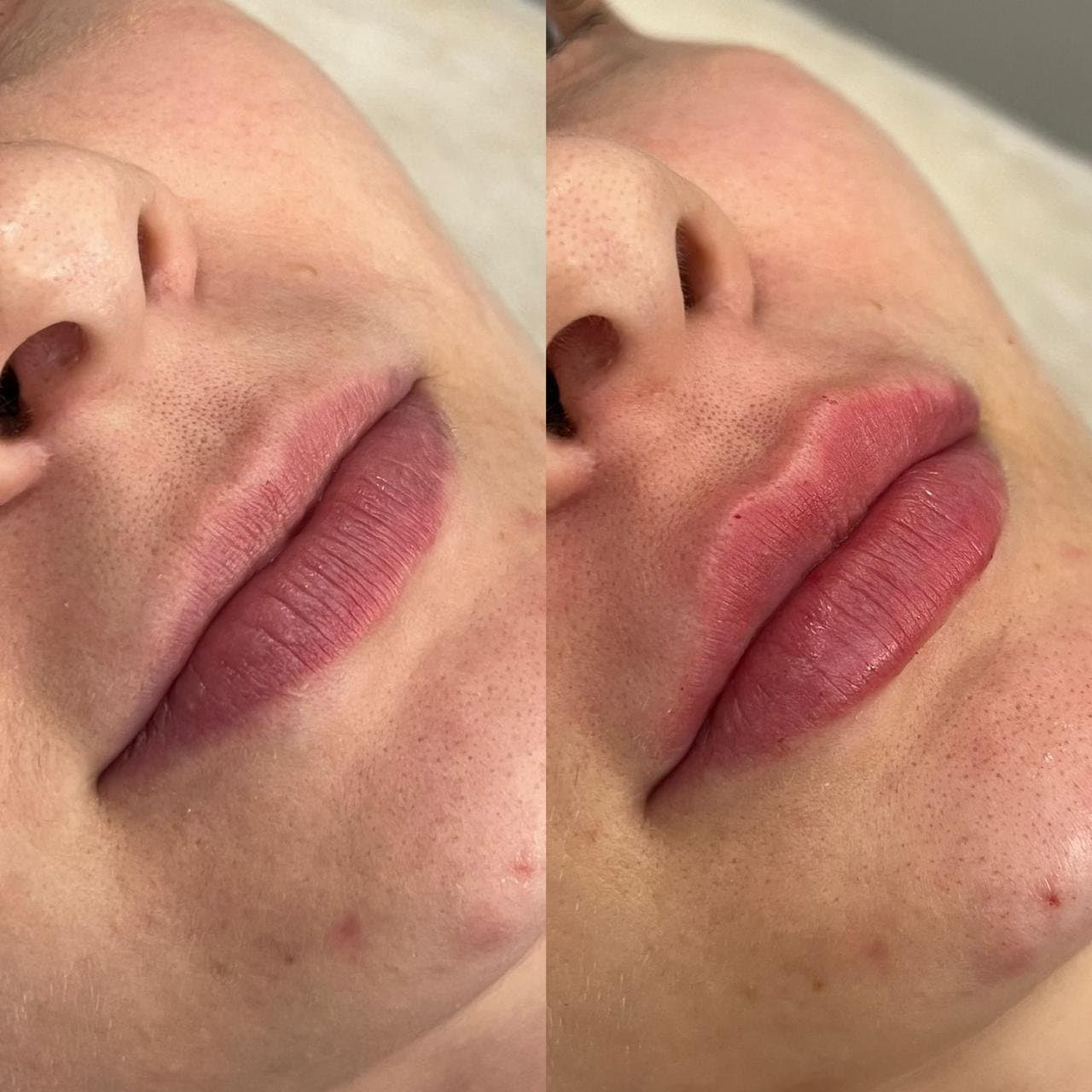 Harmonização Orofacial
